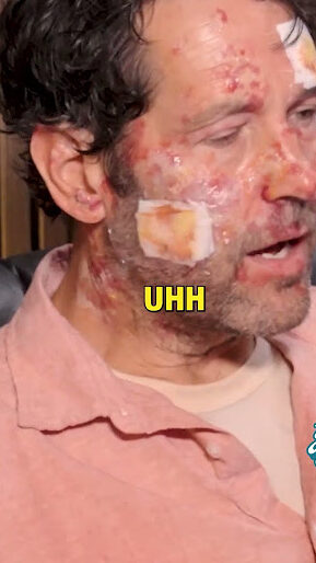 Paul Rudd injury